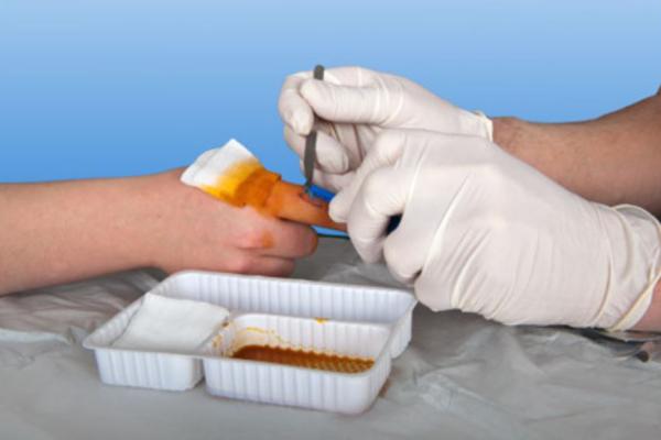 Nobamed Fadenzieh-Set steril, 10 Sets